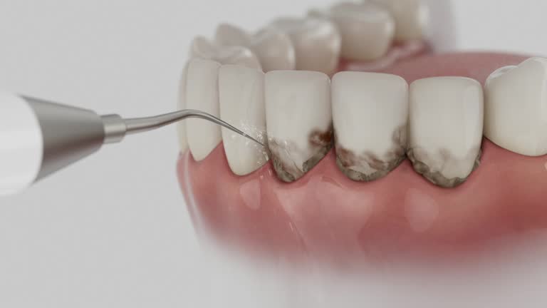 Trusted Wisdom Tooth Removal service in Fort Denaud, FL - Dentist Open Now